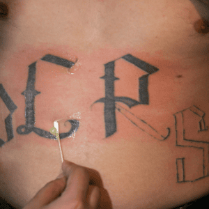 How a gang tattoo removal program is helping people start fresh