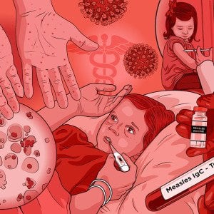 Michigan measles outbreak shows high cost of stopping even a small number of infections from spreading
