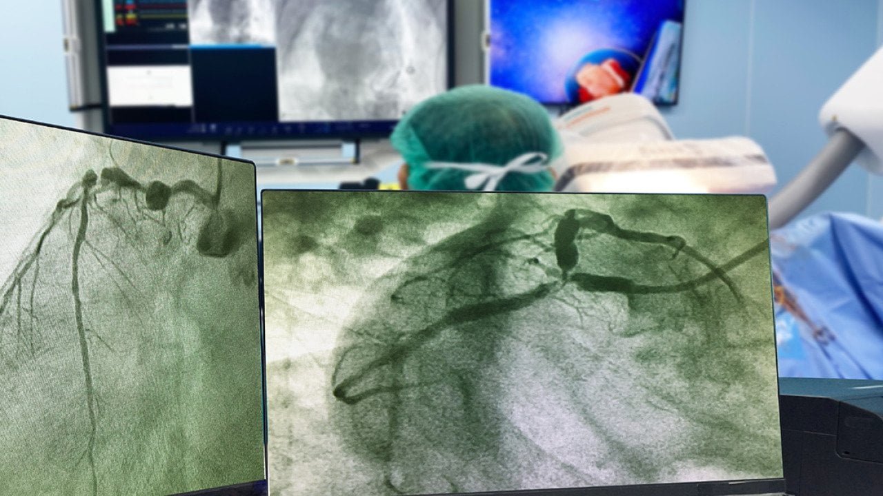 Monitors showing results of a coronary angiogram with doctors and a patient behind it.