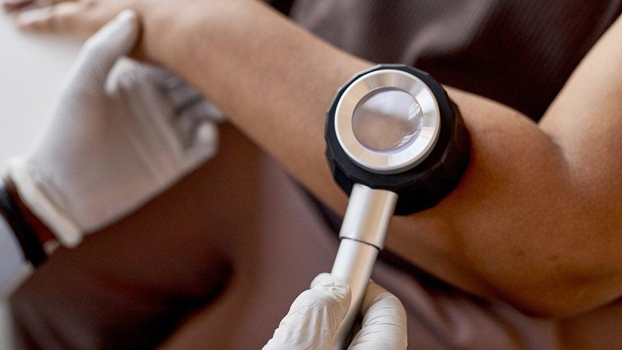 A doctor holds a dermatoscope over a patient's skin to examine for skin cancer.