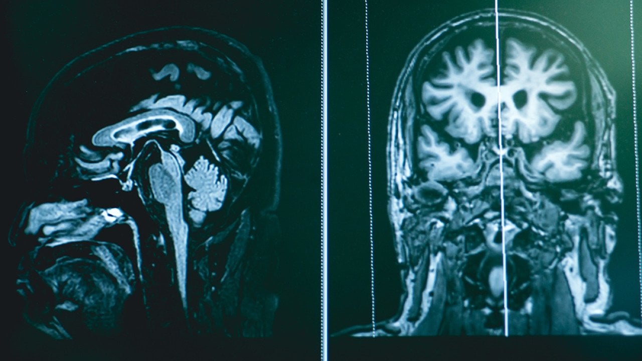 A sample MRI scan of frontotemporal dementia.
