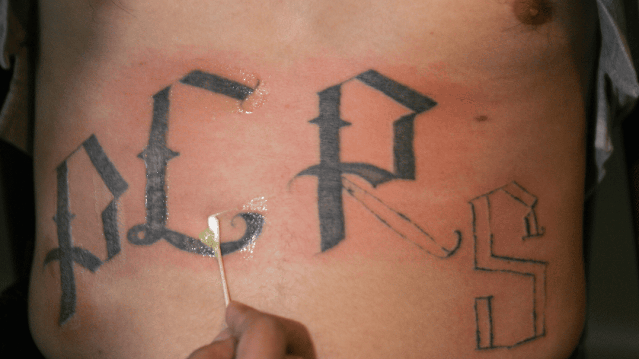 A close-up image of a person's hand using a cotton swab to apply ointment to a partially removed tattoo on the stomach of a man. The letters Y, E, R, and S are in view with part of the R and S removed. 