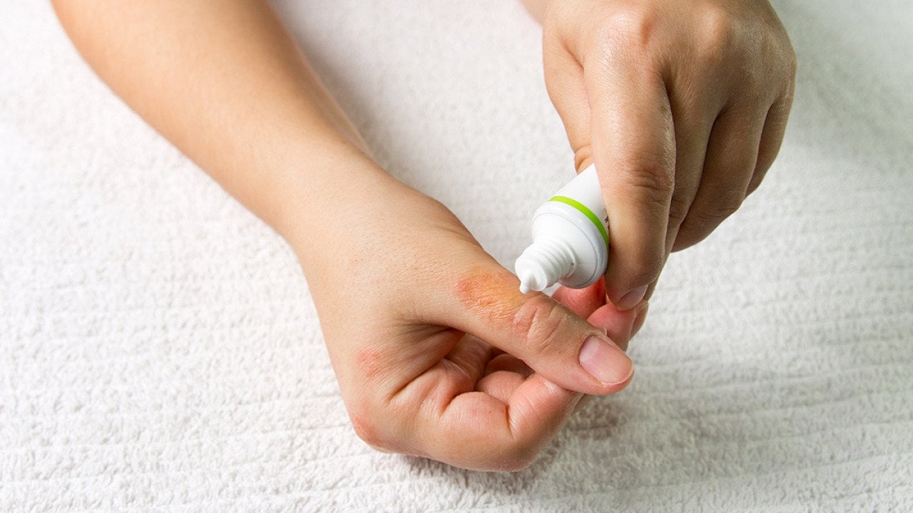 Ointment cream being applied on a right hand's thumb with eczema.