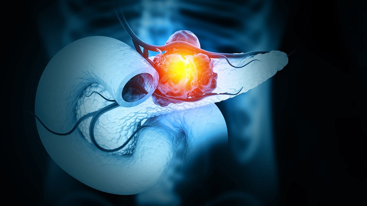 A 3D illustration of cancer forming in the pancreas.