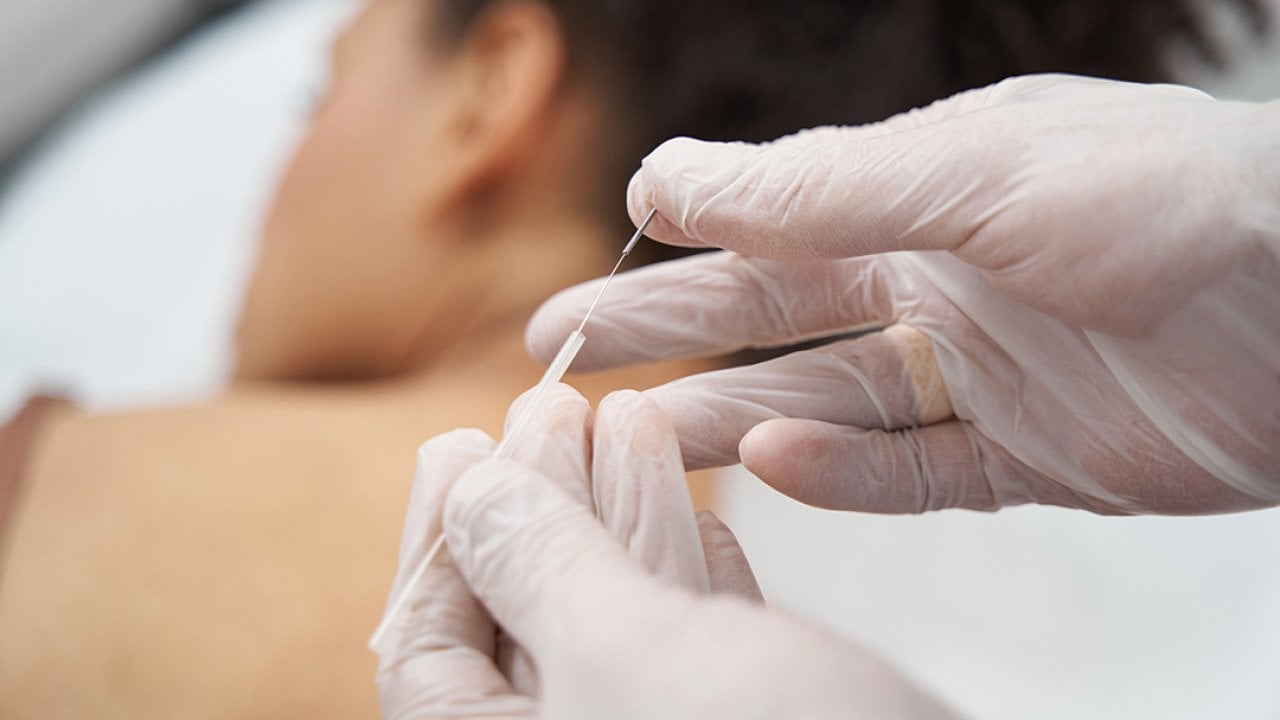 A medical worker preparing acupuncture needles for a muscle relaxation session.