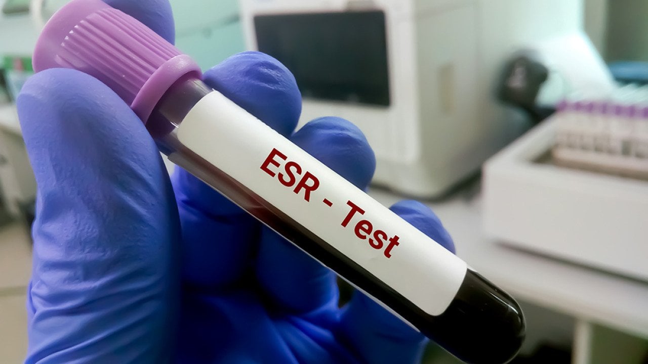 A blood sample for an erythrocyte sedimentation rate (ESR) test.