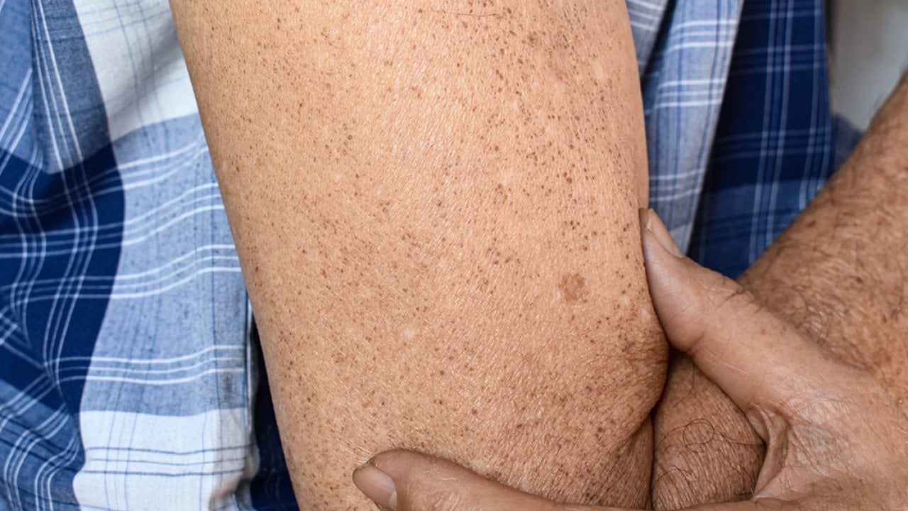 A senior person's sun spots on his arm.