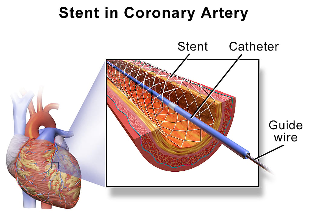 1988: Intravascular stent patented