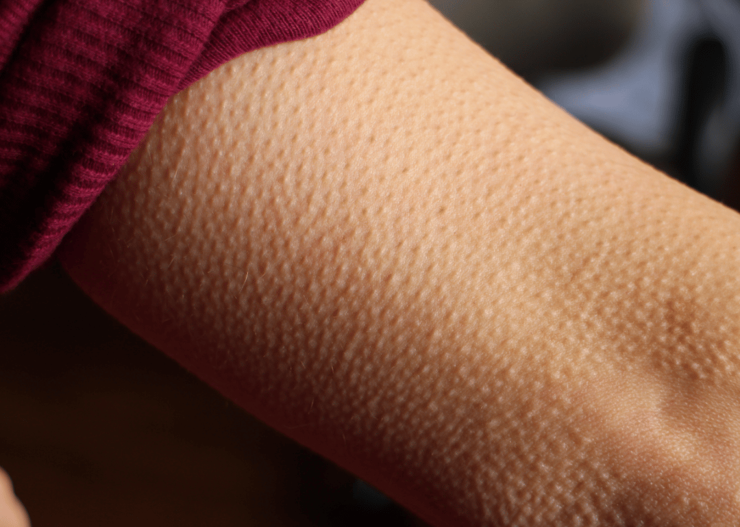 Goosebumps