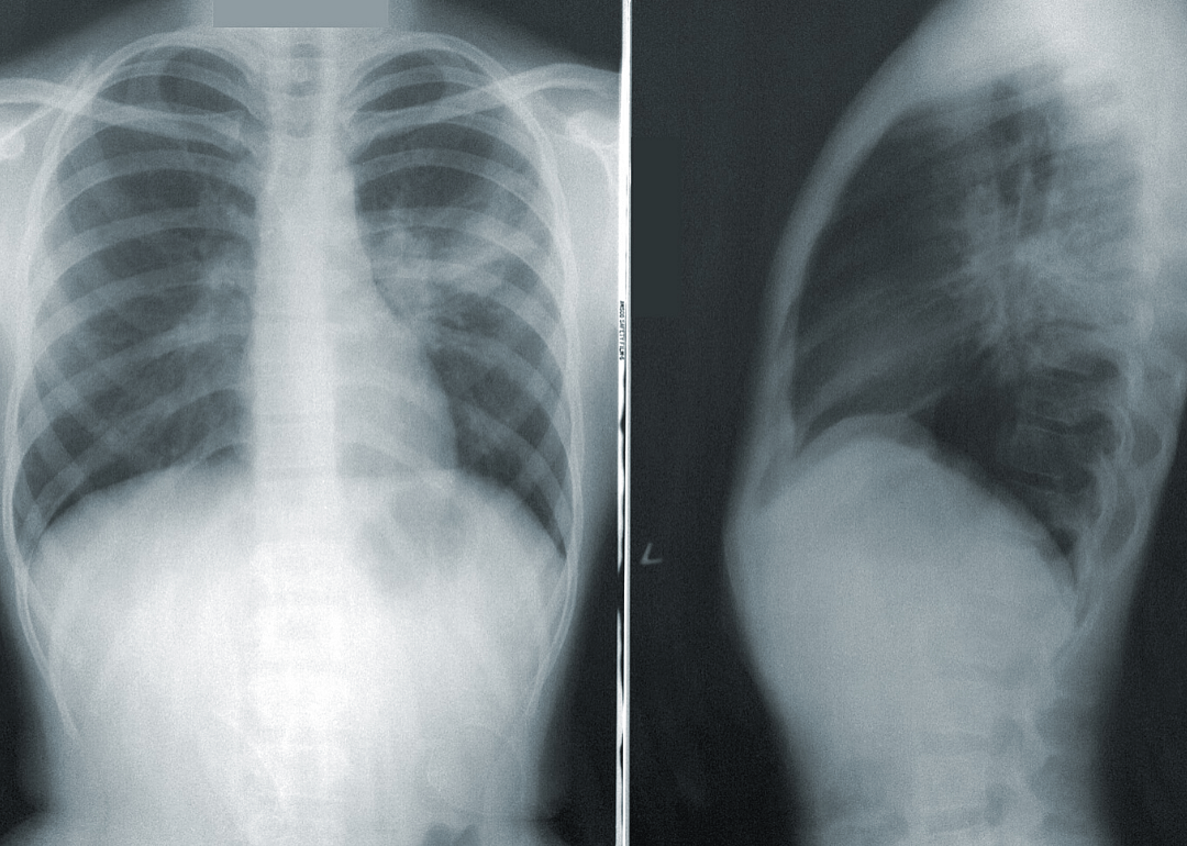 Chronic lung disease diagnosis: COVID-19 connection