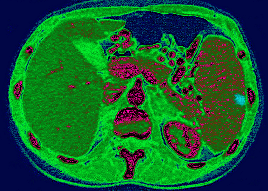 Spleen infarction, as seen on a radial section CT scan of the abdomen.