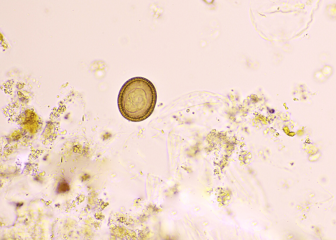 Cysticercosis