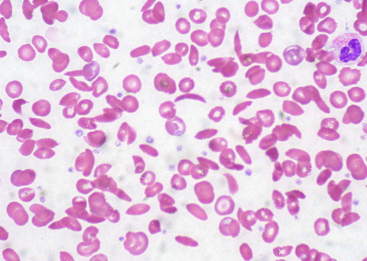 1986: Sickle cell anemia breakthrough