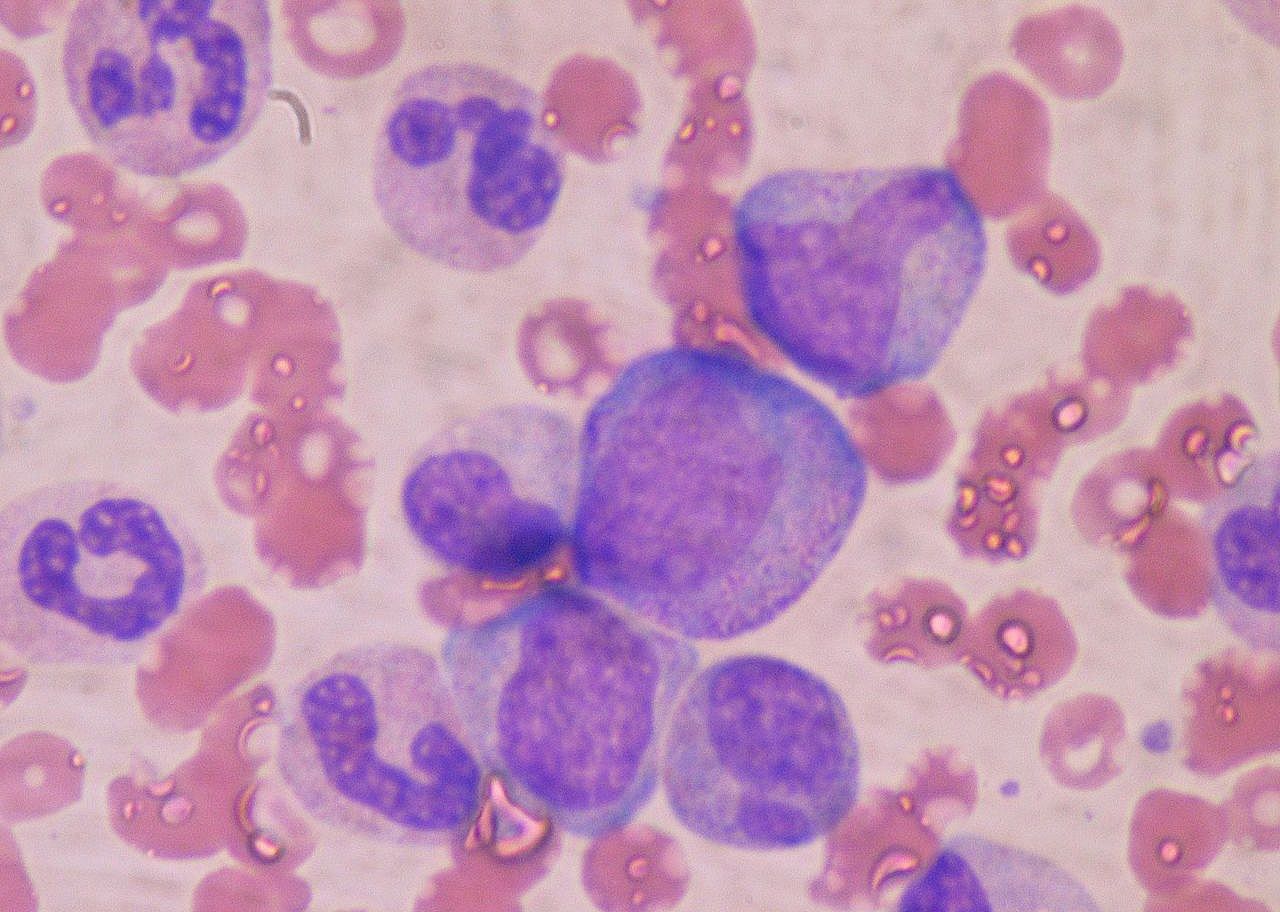 1949: First bone marrow transplant