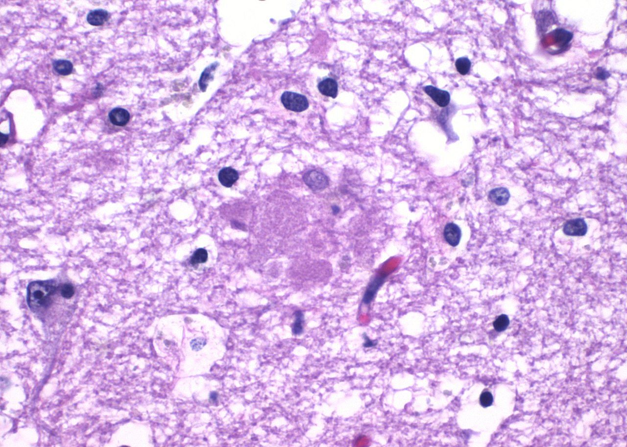 2016: Flashing light therapy to treat Alzheimer’s