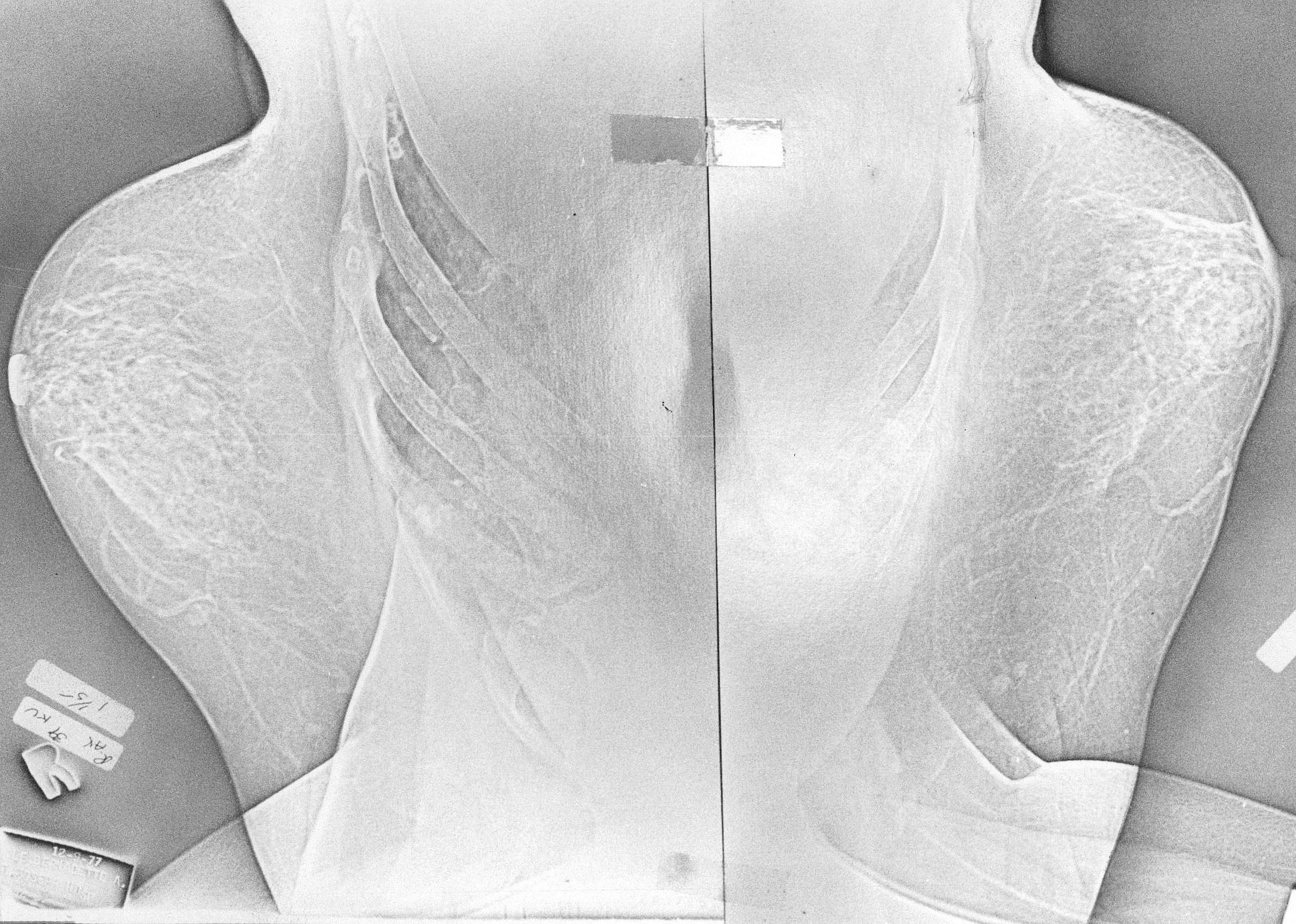 1966: First use of mammogram machine
