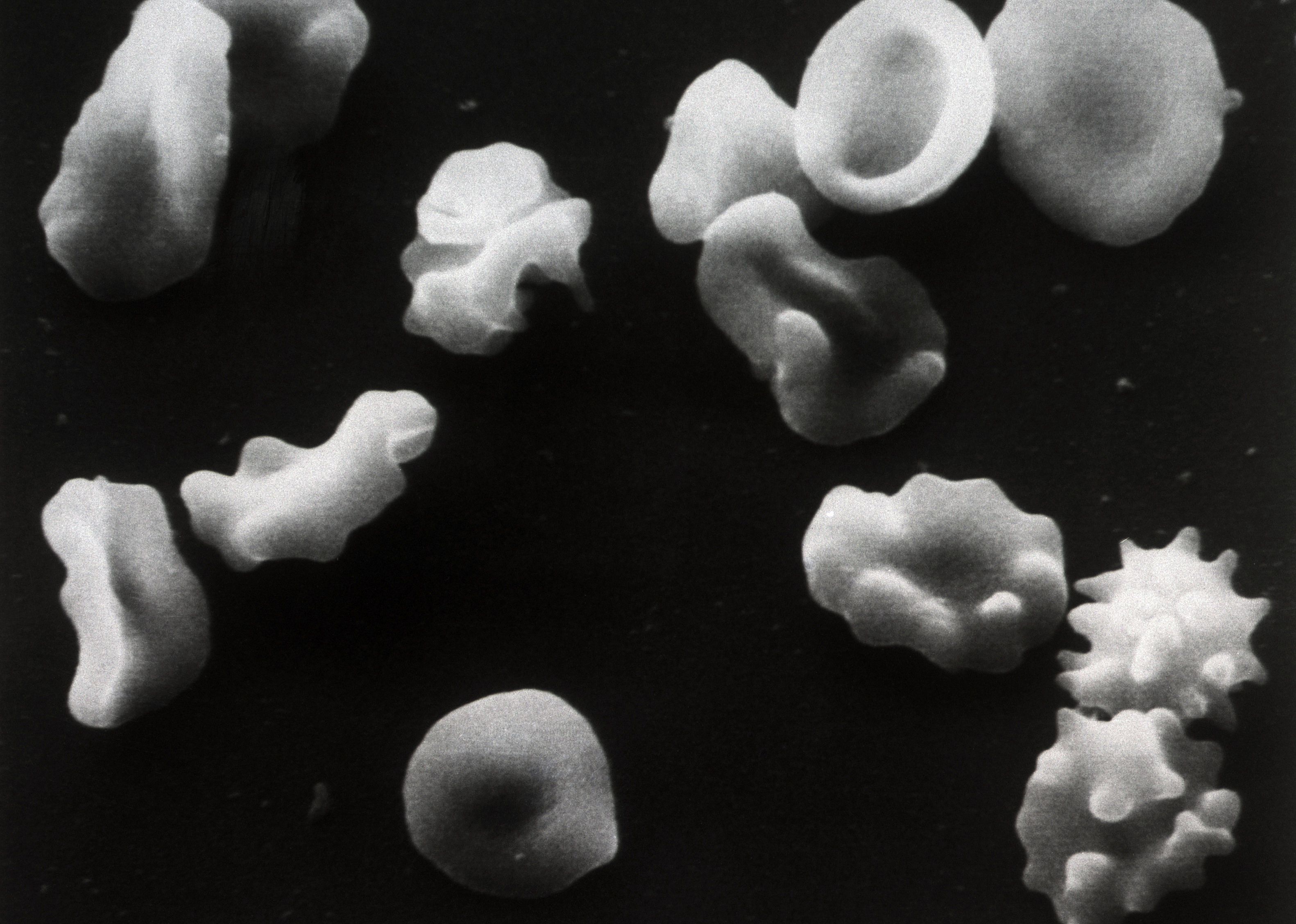 1957: Sickle cell disease breakthrough