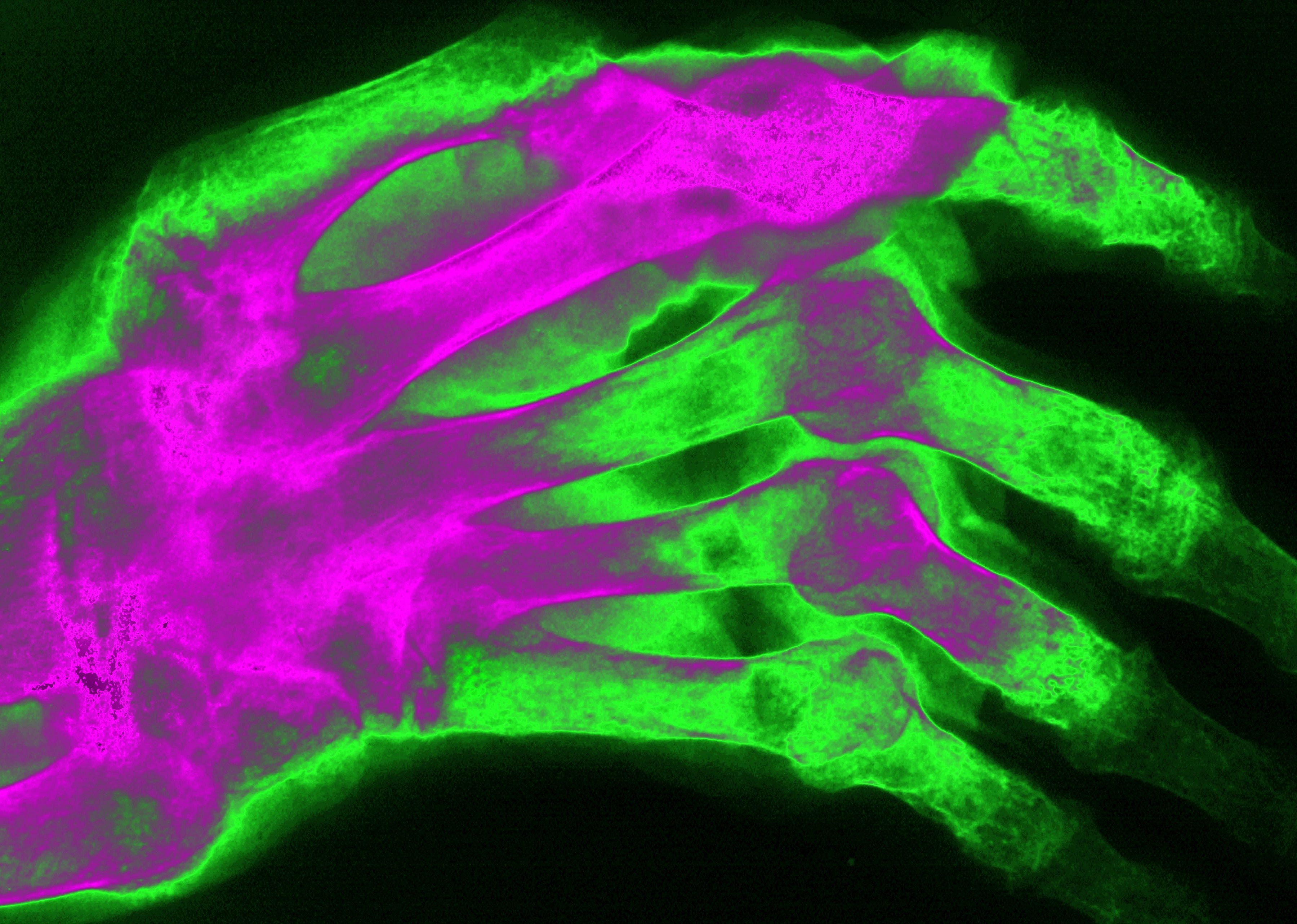 2007: Genetic basis for rheumatoid arthritis discovered