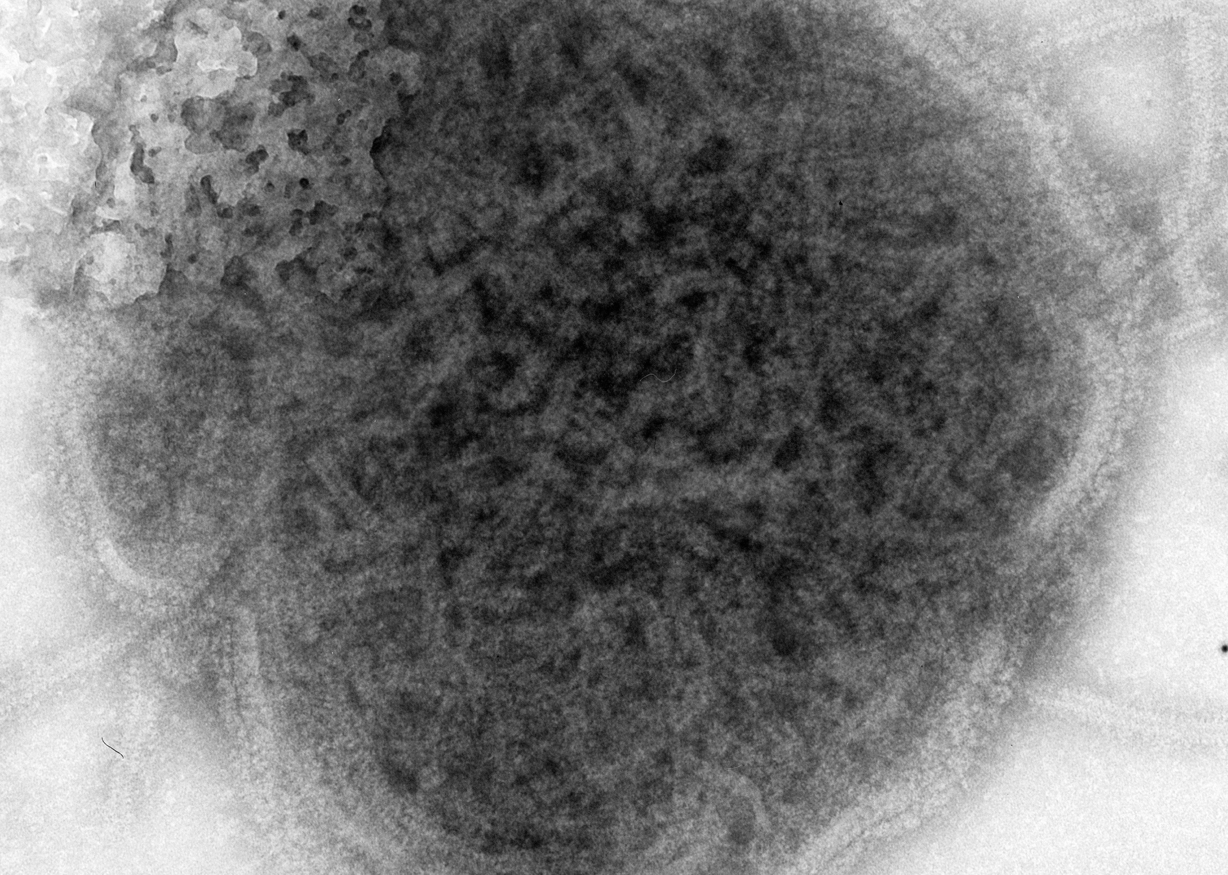 1967: First mumps vaccine