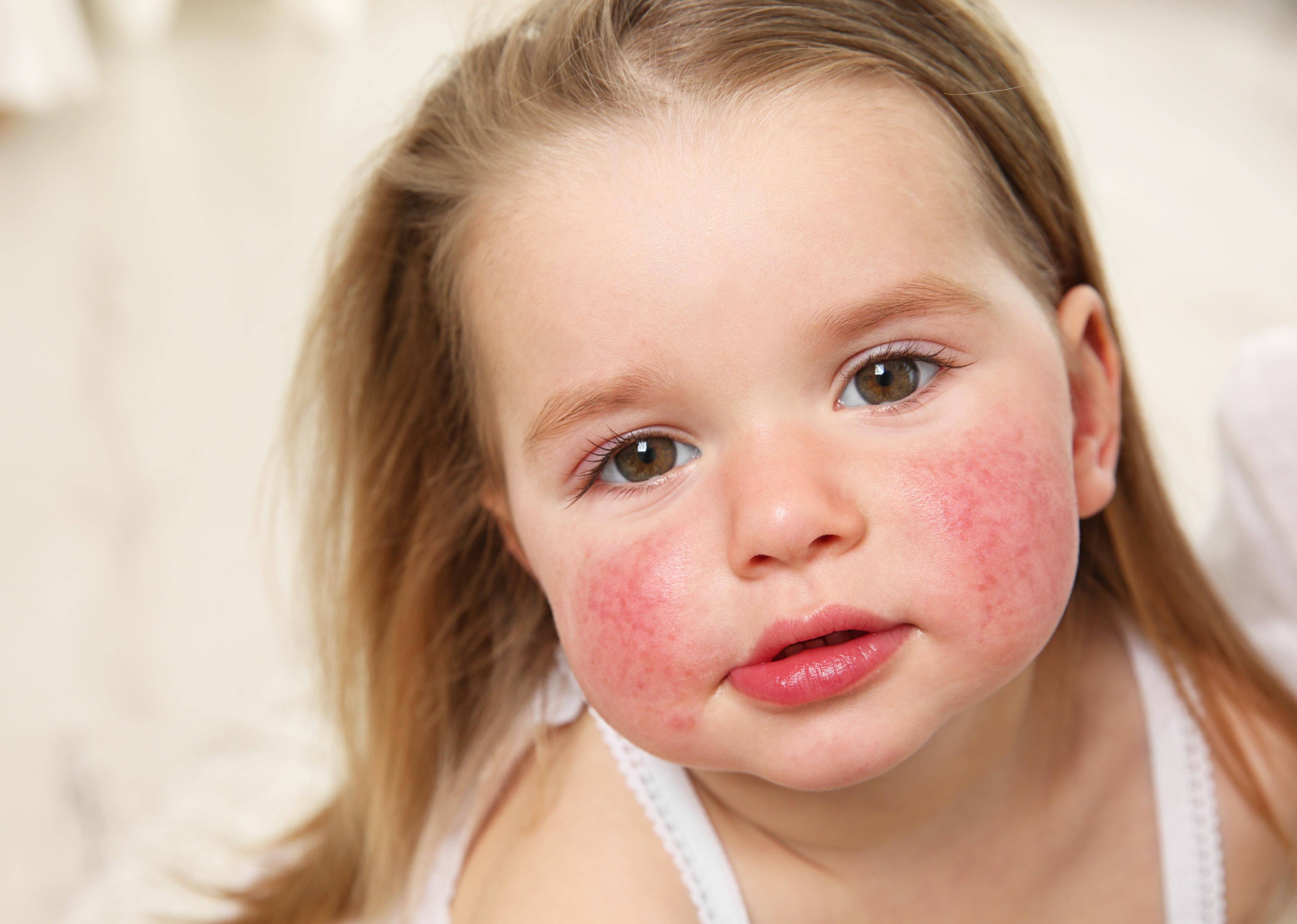 Food allergy symptoms appear within two hours 
