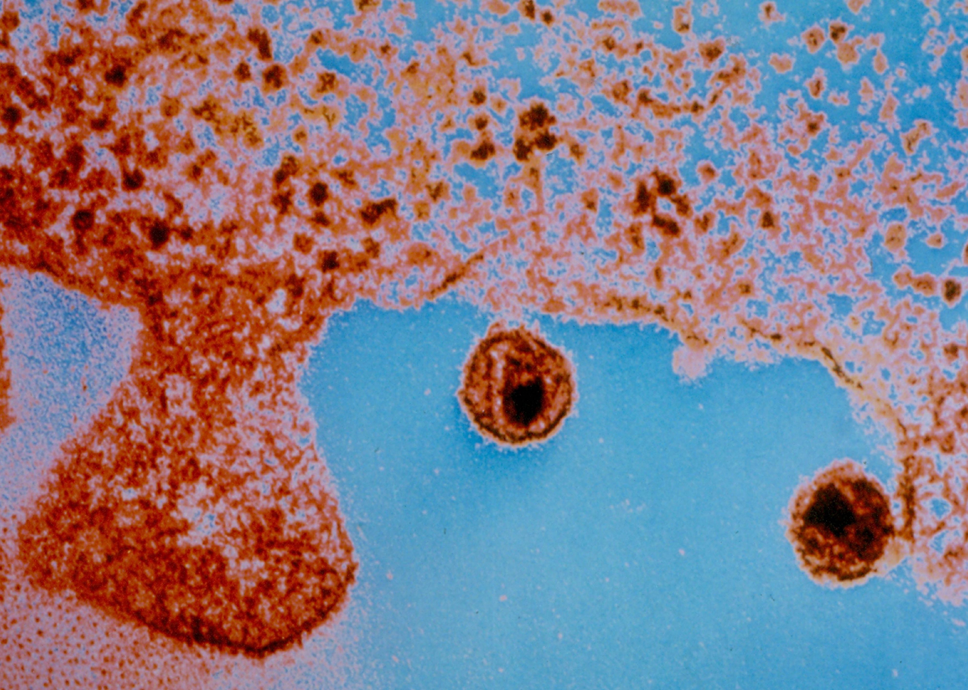 1981: First AIDS cases