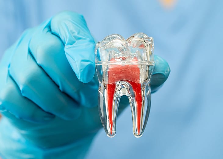 A dentist holding a dental implant model of a tooth.