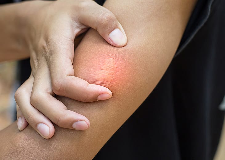 A bee sting stuck from a person's arm. 