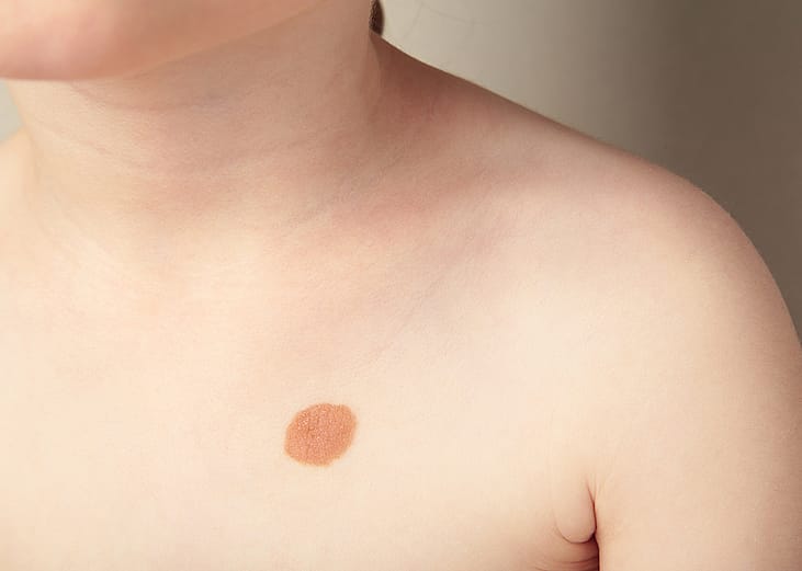 A close-up shot of a big mole on the left side of a child's chest.