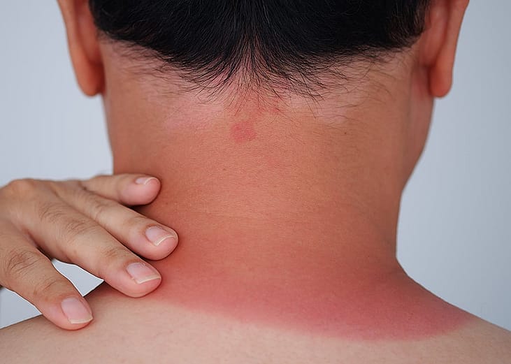 Redness on a man's neck as an effect of sunburn.