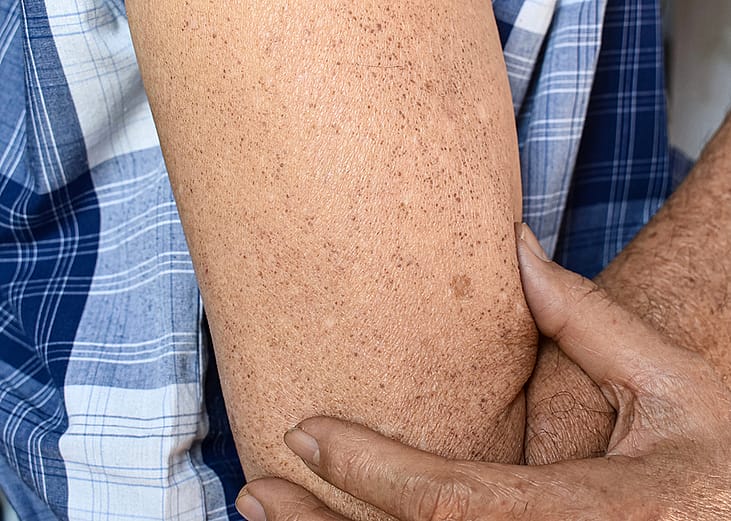 A senior person's sun spots on his arm.
