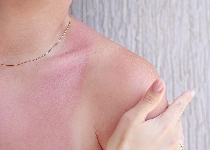 A person's shoulders with sunburn after exposure.