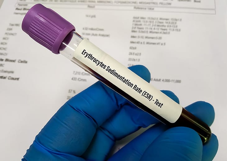 A blood sample vial collected for an erythrocyte sedimentation rate (ESR) test.