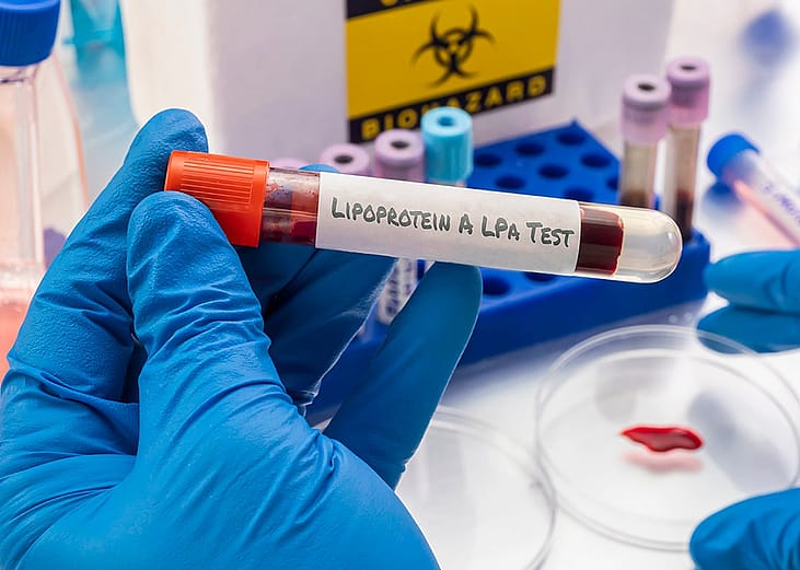 A scientist holding a vial containing a blood sample to analyse for lipoprotein(a).