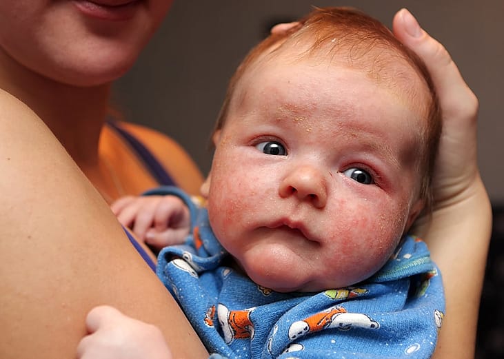 A baby with red, dry, inflamed, and flaky patches on the cheeks, forehead, and around the eyes.