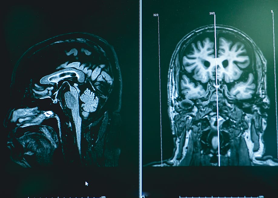 A sample MRI scan of frontotemporal dementia. — Atthapon Raksthaput // Shutterstock