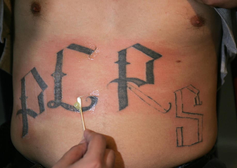 A close-up image of a person's hand using a cotton swab to apply ointment to a partially removed tattoo on the stomach of a man. The letters Y, E, R, and S are in view with part of the R and S removed. — ROBYN BECK // AFP via Getty Images