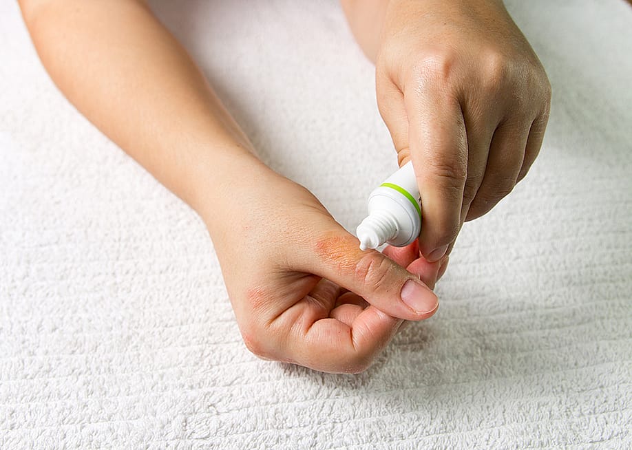 Ointment cream being applied on a right hand's thumb with eczema. — SMAK_Photo // Shutterstock