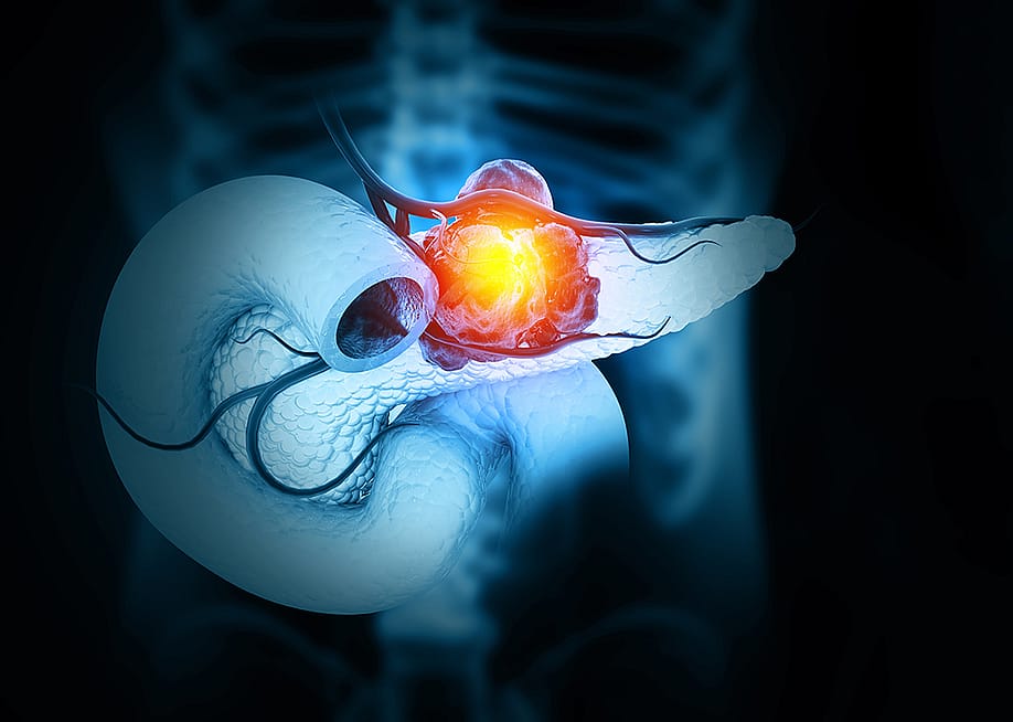 A 3D illustration of cancer forming in the pancreas. — crystal light // Shutterstock