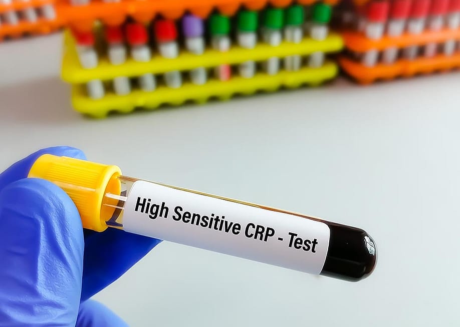 A blood sample tube for hs-CRP (high-sensitive CRP) test. — Saiful52 // Shutterstock