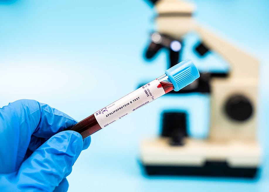 A blood sample labelled for an Apolipoprotein B test. — luchschenF // Shutterstock