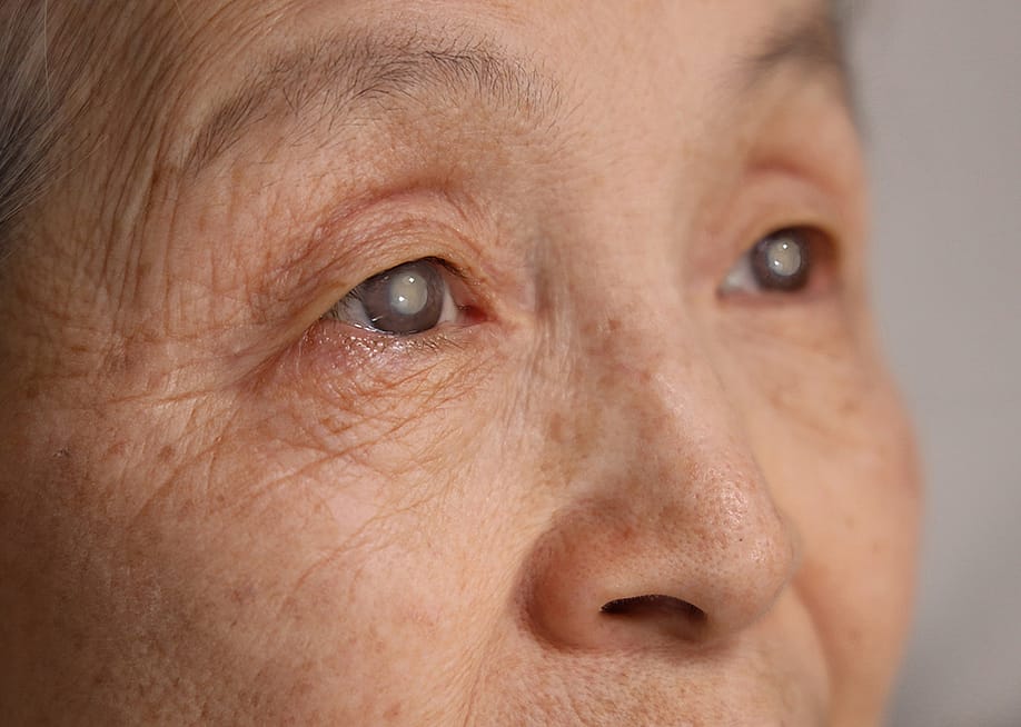 Close up on an elderly woman's eyes with cataracts. — VPLAB // Shutterstock