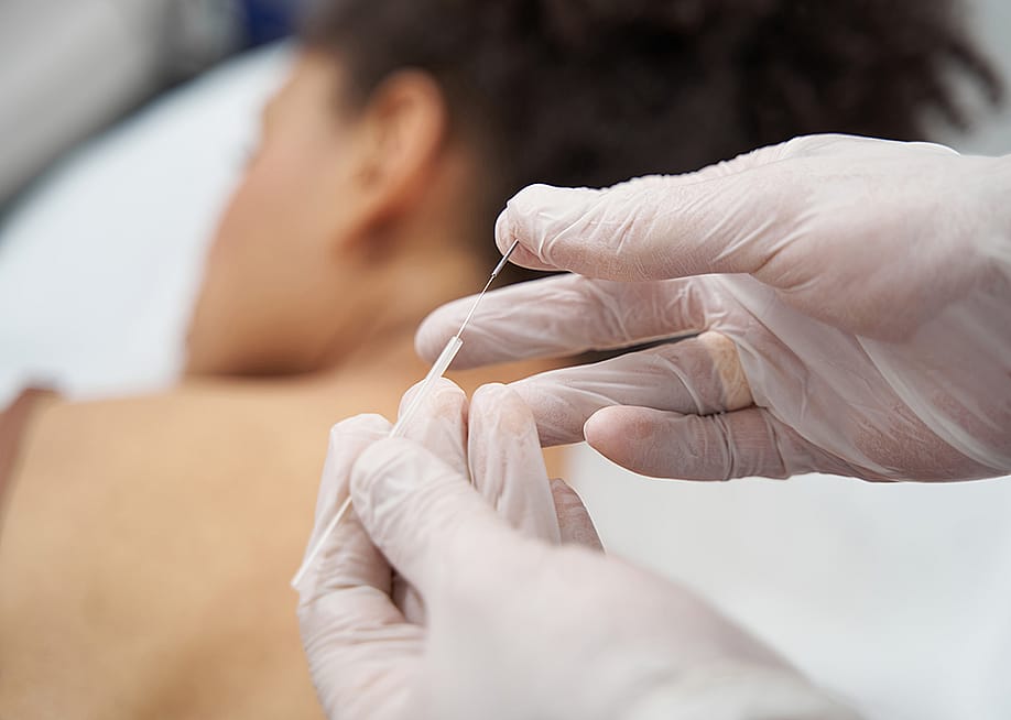 A medical worker preparing acupuncture needles for a muscle relaxation session. — Svitlana Hulko // Shutterstock