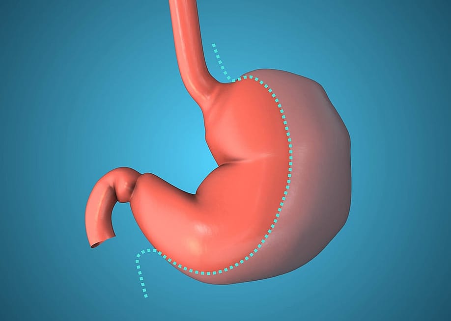 A 3D illustration of the gastric sleeve which is a target for bariatric surgery. — Orange Lantern // Shutterstock