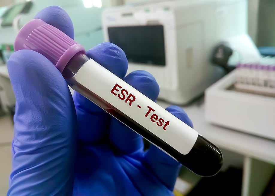 A blood sample for an erythrocyte sedimentation rate (ESR) test. — Saiful52 // Shutterstock