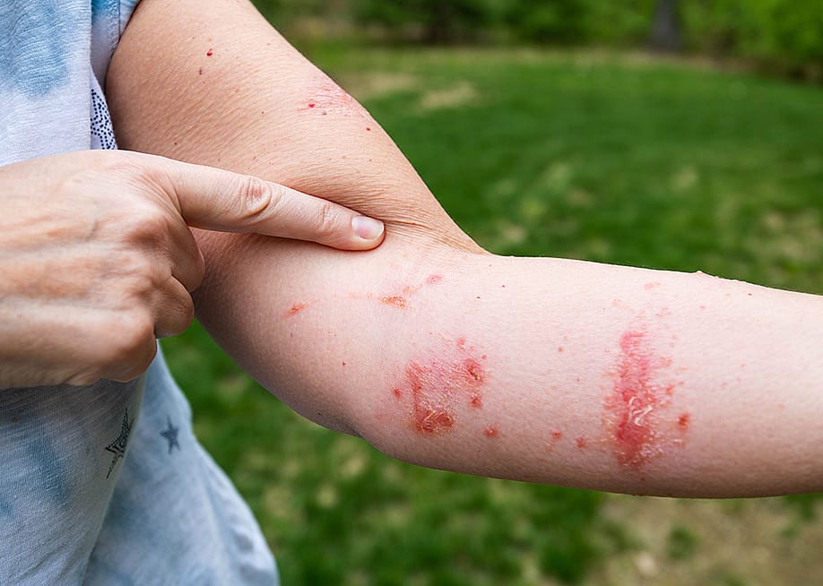 Person pointing at their arm where poison ivy rash has spread. — Michael Moloney // Shutterstock