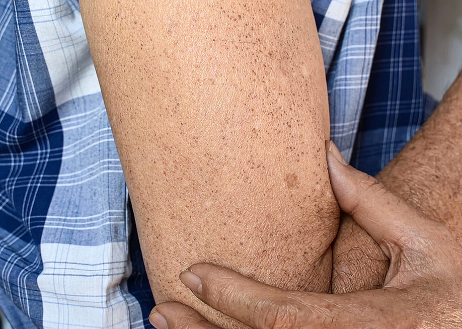 A senior person's sun spots on his arm. — Zay Nyi Nyi // Shutterstock
